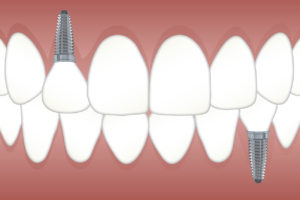 Impianti Dentali Impianti Dentali