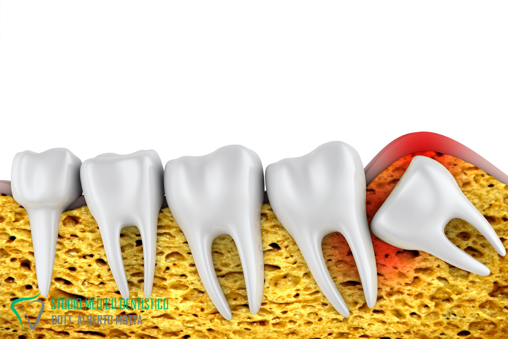 per il dente incluso si ricorre alla chirurgia orale