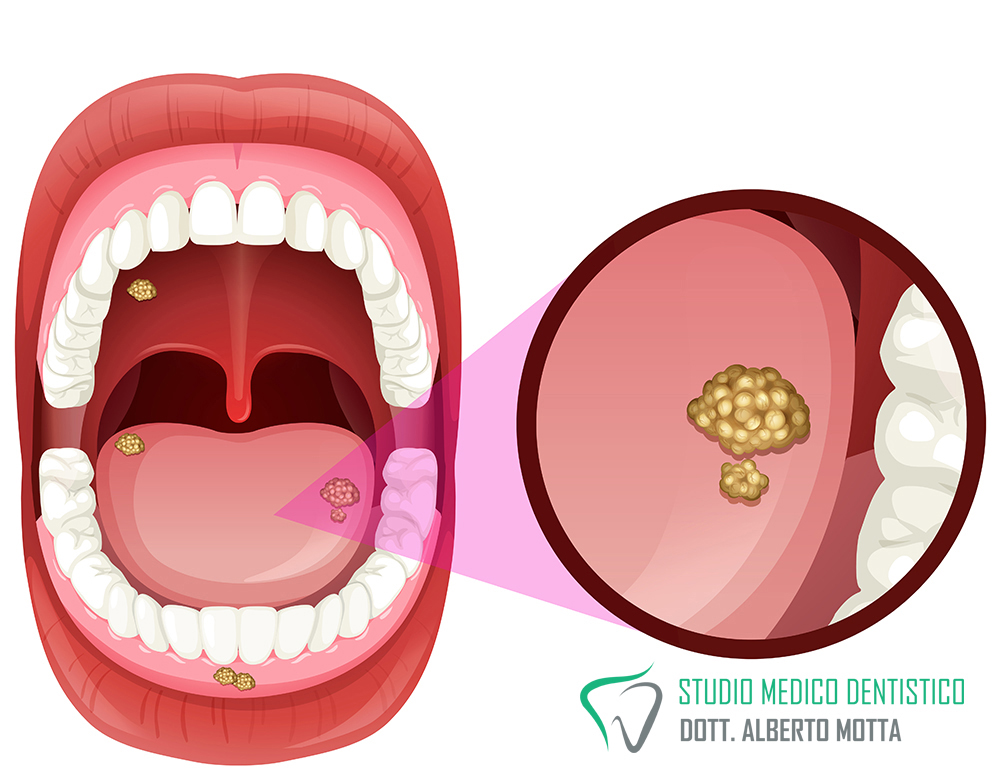 Patologia orale per diagnosticare le ulcere, immagine di bocca aperta con escrescenze