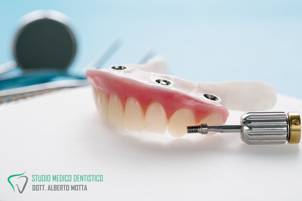 implantologia: impianto dentale fisso