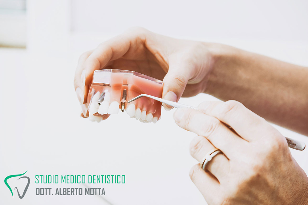 implantologia dentale