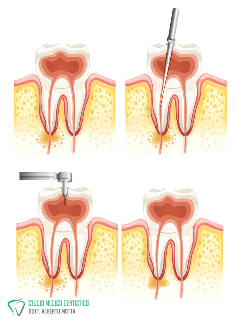 cura canalare in endodonzia