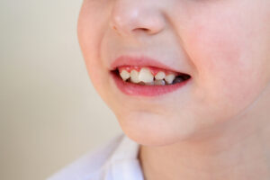 Affollamento dentale: cos’è e come correggerlo