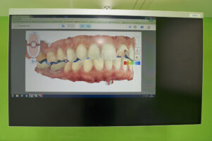 Impronte dentali digitali: cosa sono, come si fanno, costi